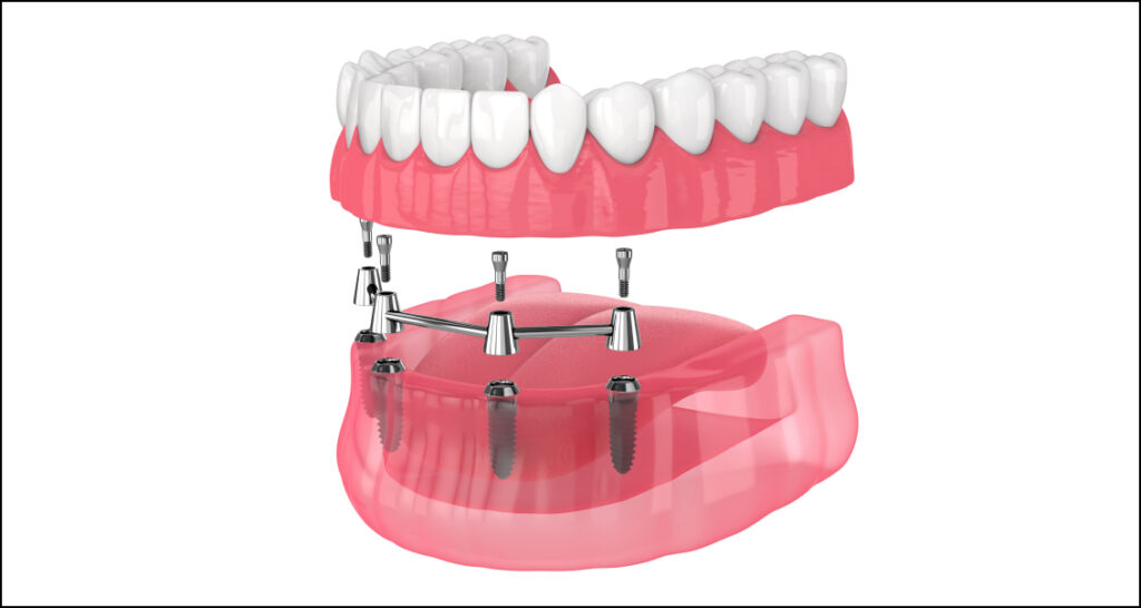 Implant Supported Dentures