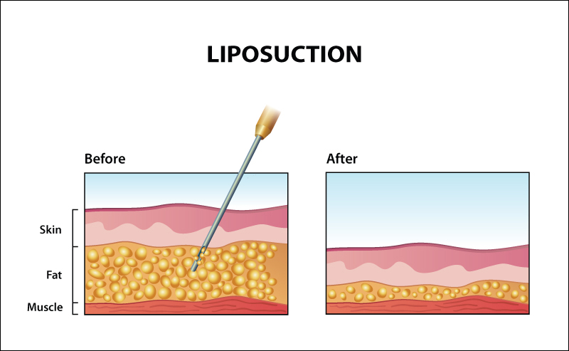 Liposuction before and after