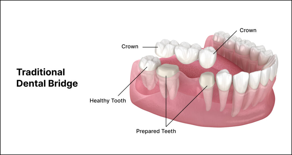 Traditional Dental Bridge