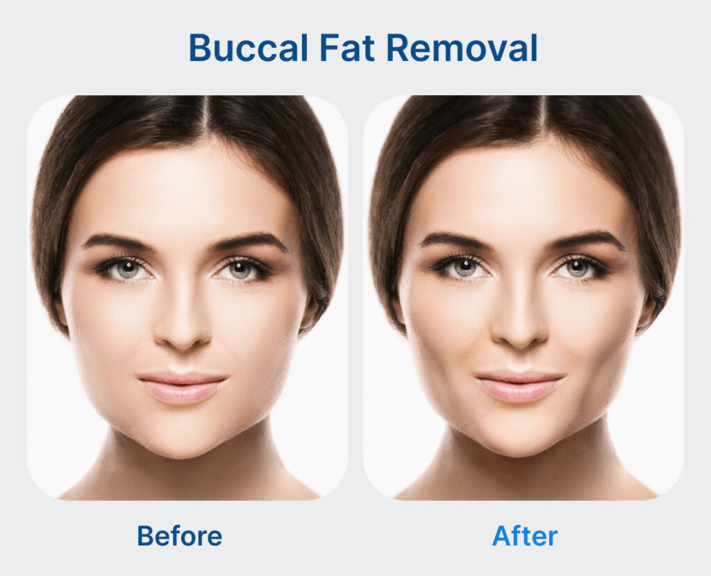 Buccal-Fat-Removal-before-and-after