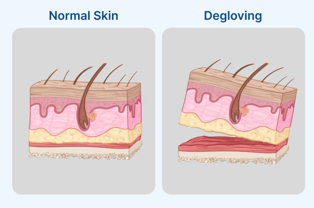 What Is Degloving