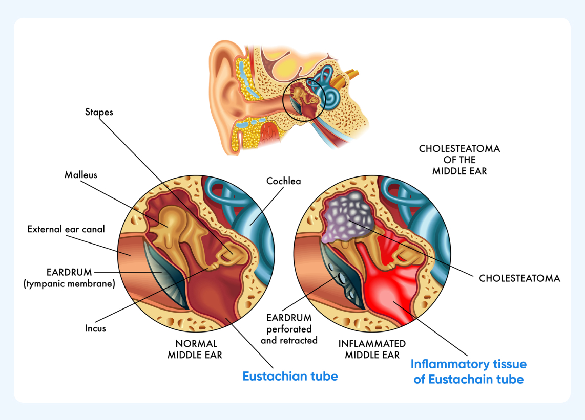 What Is an Ear Infection